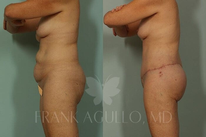Body Lift Before and After 3