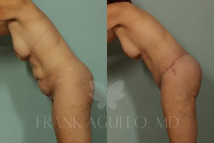 Body Lift Before and After 4