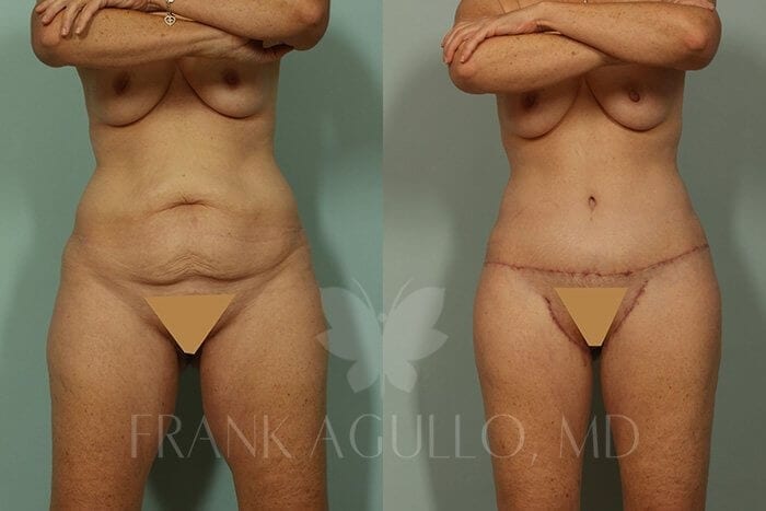 Body Lift Before and After 7