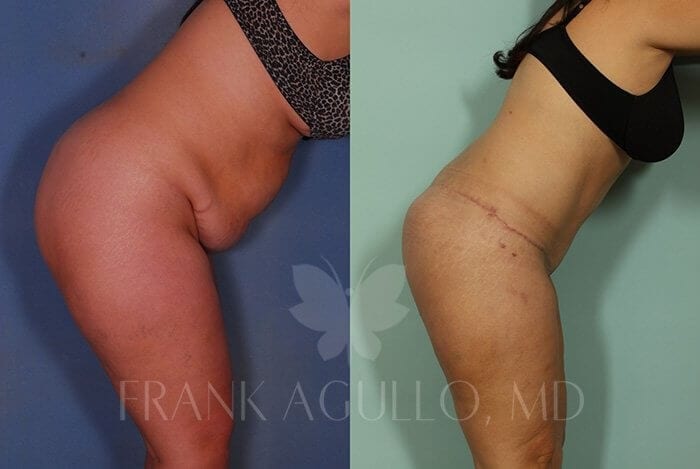 Body Lift Before and After 2