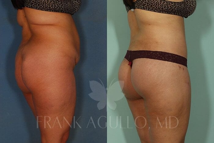 Body Lift Before and After 9