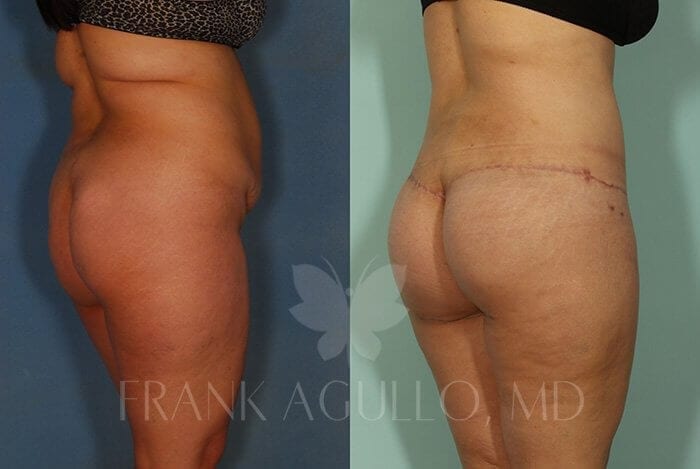 Body Lift Before and After 10