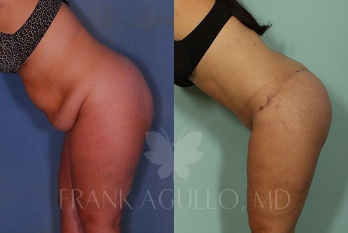 Body Lift Before and After 11