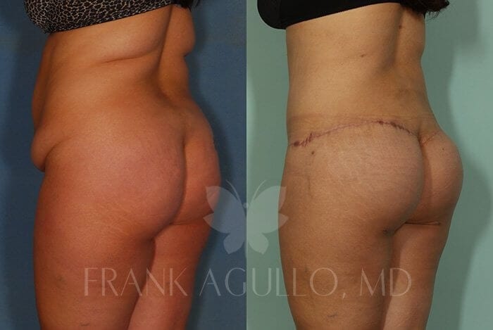 Body Lift Before and After 3