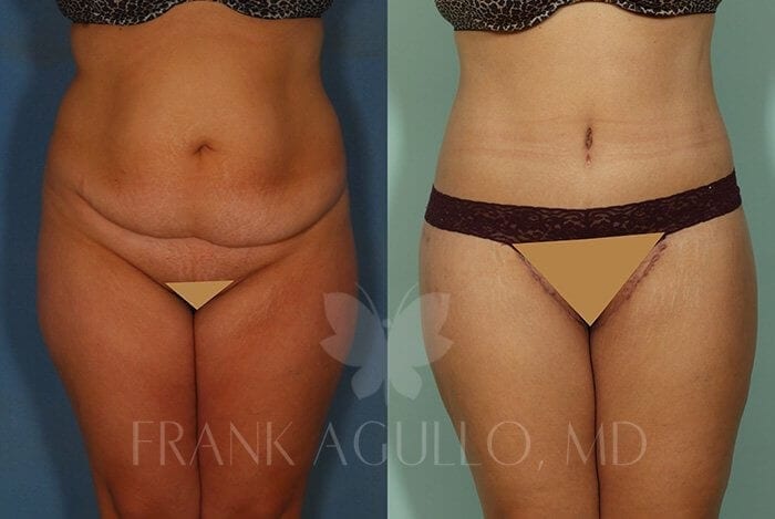Body Lift Before and After 4