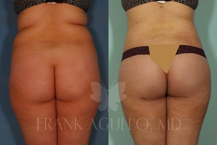 Body Lift Before and After 12
