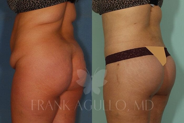 Body Lift Before and After 5