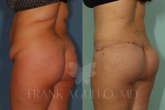 Body Lift Before and After 6