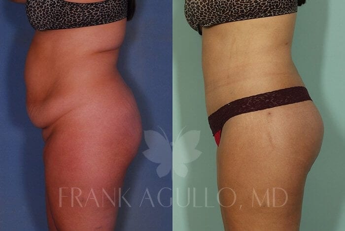 Body Lift Before and After 8