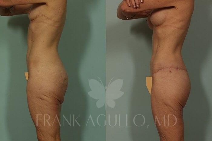 Body Lift Before and After 3