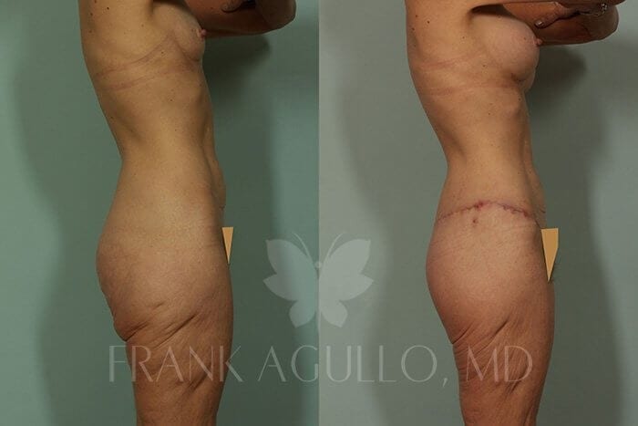 Body Lift Before and After 4
