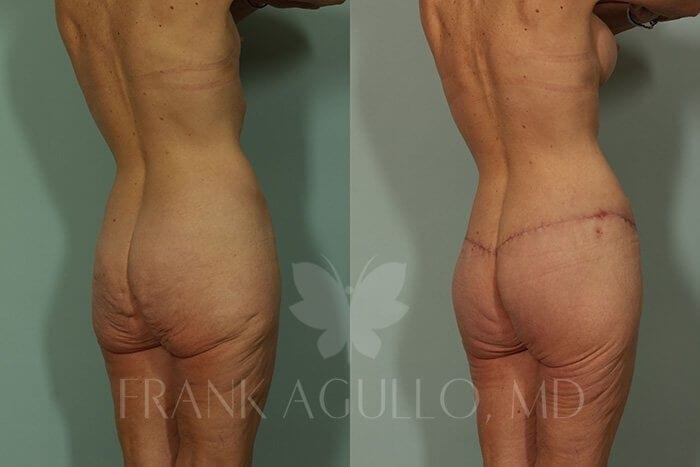 Body Lift Before and After 5