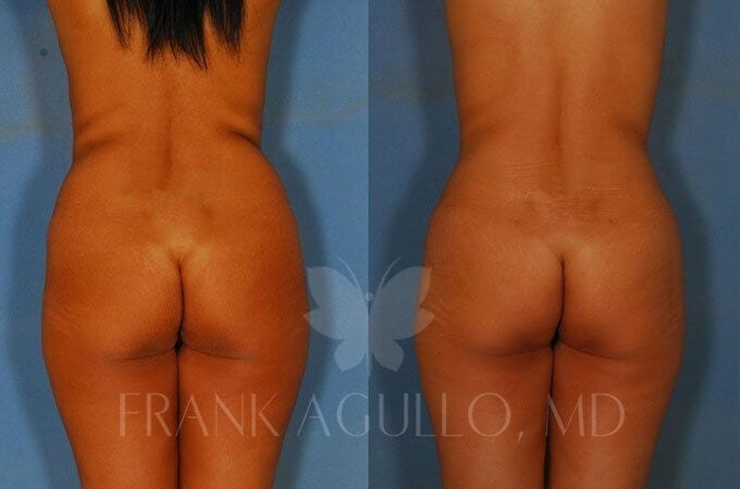 Brazilian Butt Lift Before and After 2
