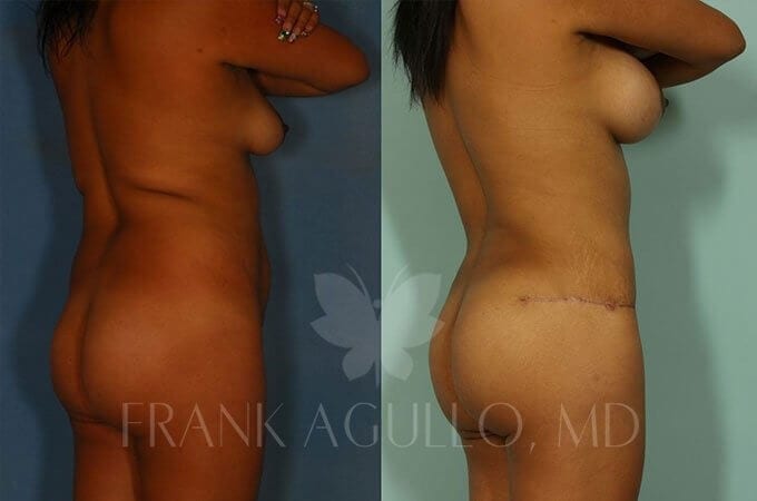 Brazilian Butt Lift Before and After 9