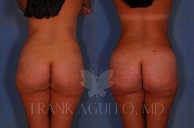 Brazilian Butt Lift Before and After 20