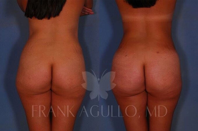 Brazilian Butt Lift Before and After 11