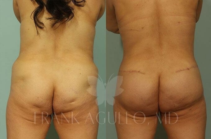 Brazilian Butt Lift Before and After 10