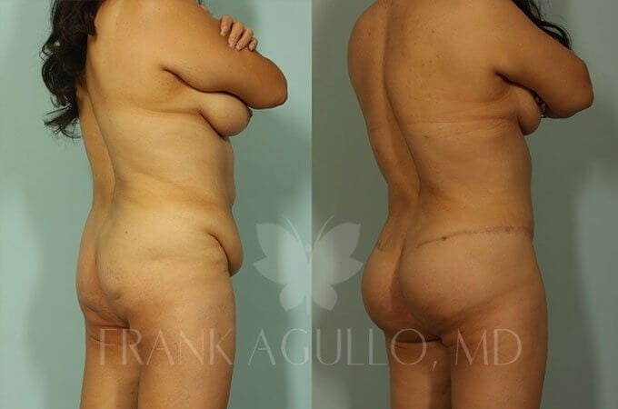 Brazilian Butt Lift Before and After 3