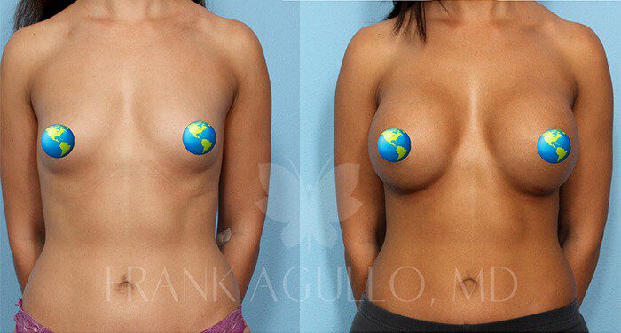 Breast Augmentation Before and After 7