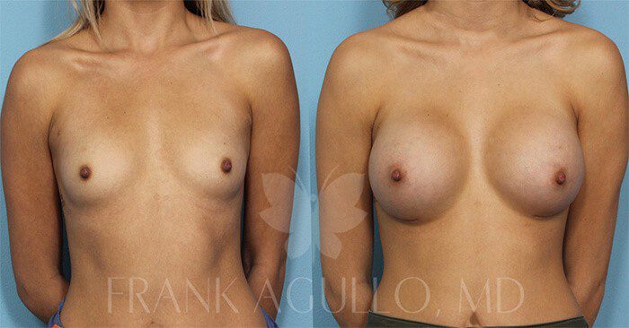 Breast Augmentation Before and After 6