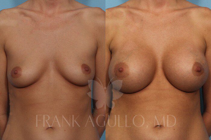 Breast Augmentation Before and After 5