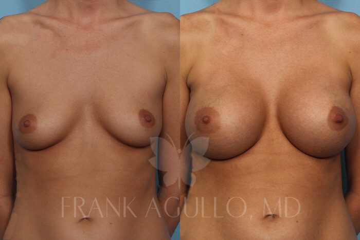 Breast Before and After 8