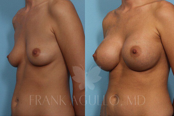 Breast Augmentation Before and After 2