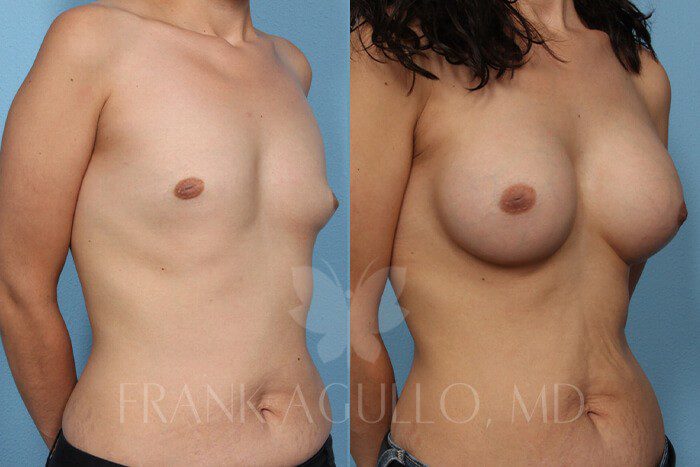 Breast Before and After 7