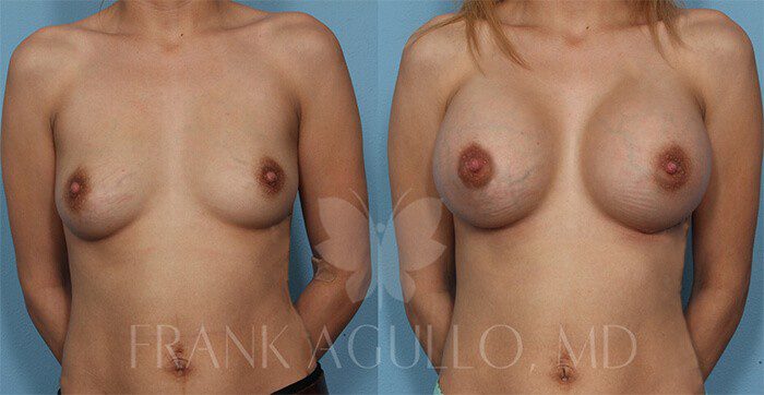Breast Augmentation Before and After 3