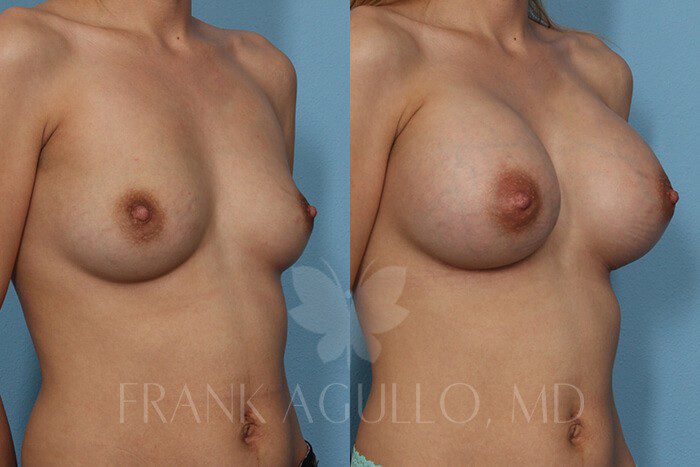 Breast Augmentation Before and After 2