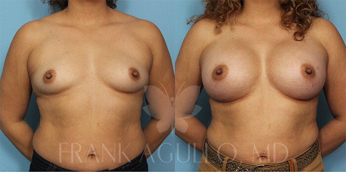 Breast Augmentation Before and After 2
