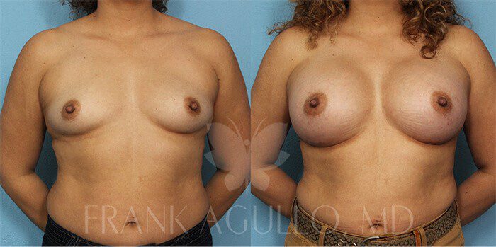 Breast Before and After 5