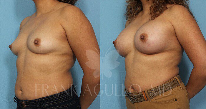 Breast Augmentation Before and After 2
