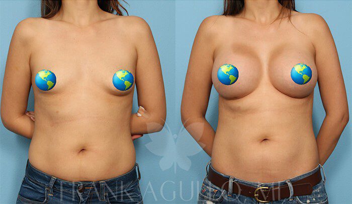 Breast Before and After 4