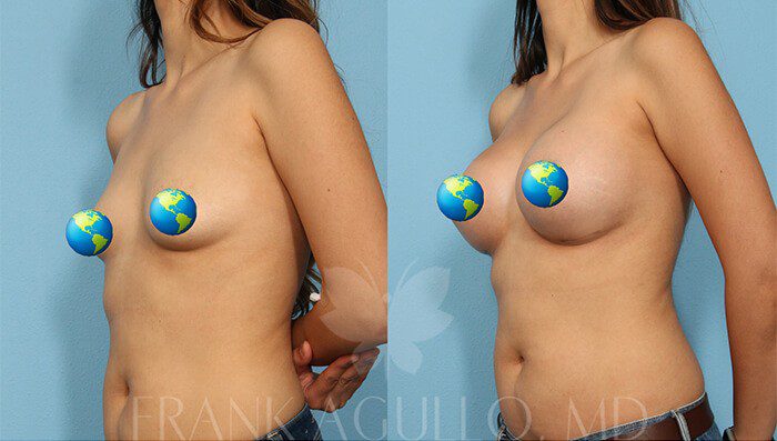 Breast Augmentation Before and After 2