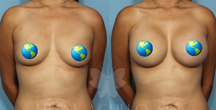 Breast Before and After 3