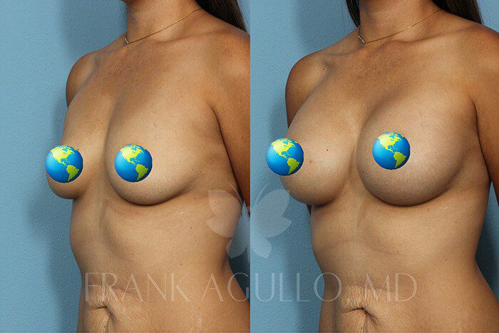 Breast Augmentation Before and After 2