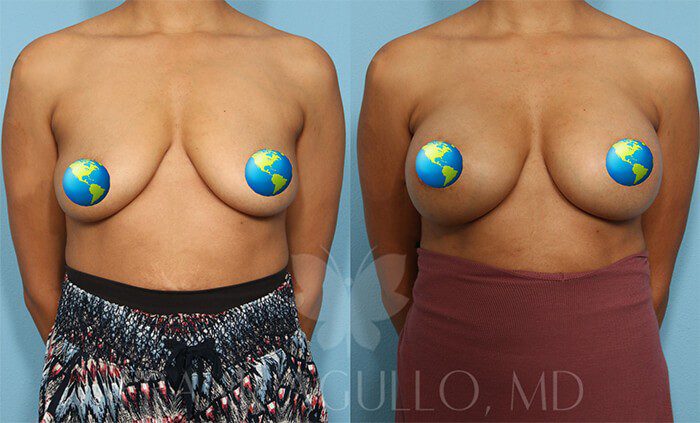 Breast Augmentation Before and After 19