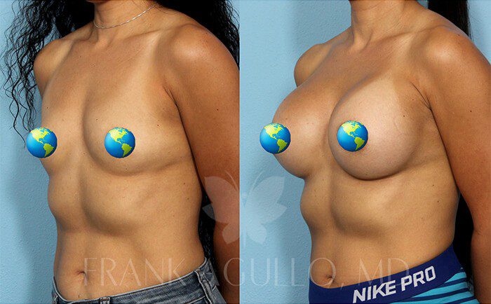 Breast Augmentation Before and After 2