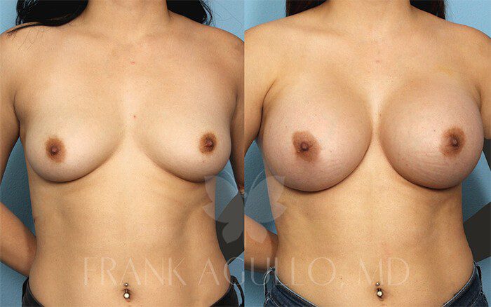 Breast Augmentation Before and After 17