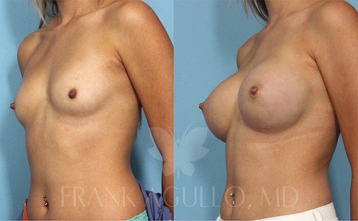 Breast Augmentation Before and After 15