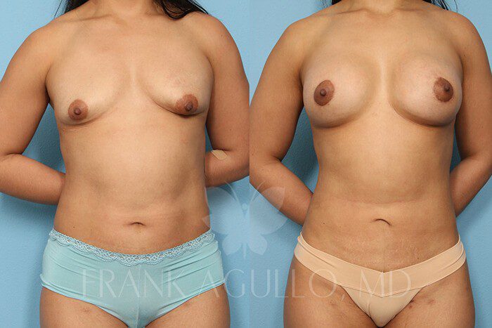 Breast Augmentation Before and After 14