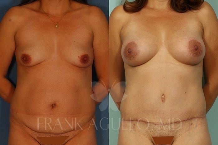 Breast Augmentation Before and After 2
