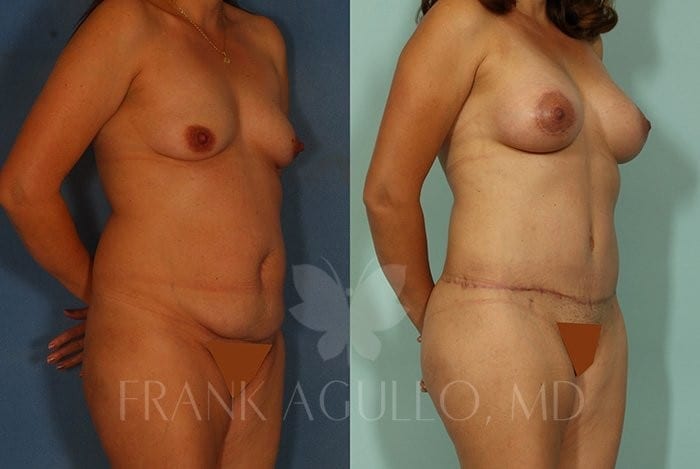 Breast Augmentation Before and After 20