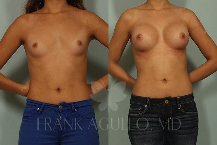 Breast Before and After 2