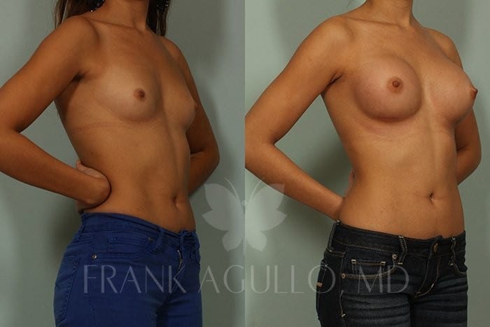 Breast Augmentation Before and After 2