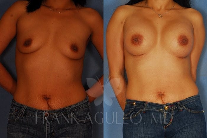 Breast Before and After 1