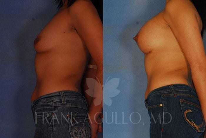 Breast Augmentation Before and After 3