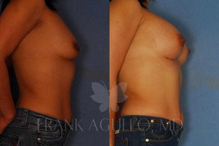 Breast Augmentation Before and After 4