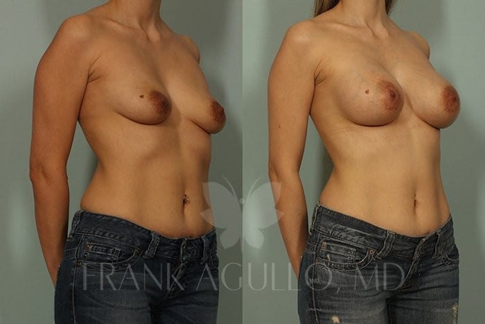 Breast Augmentation Before and After 2